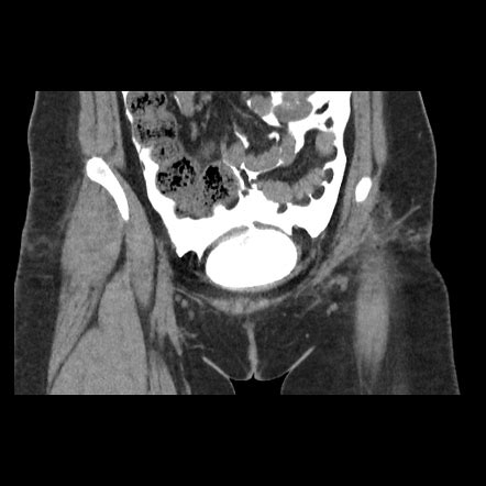 20k bladder tear test|bladder injury treatment.